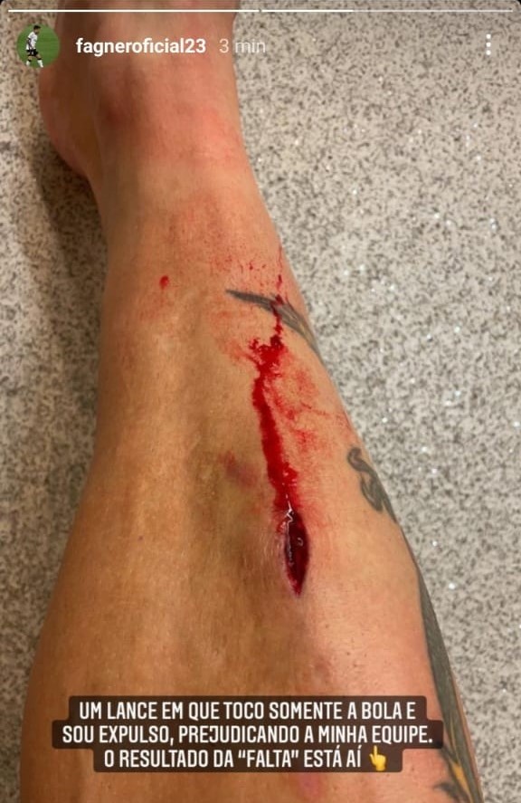 Fagner postou o corte na perna após a partida - Foto: Reprodução/Instagram.