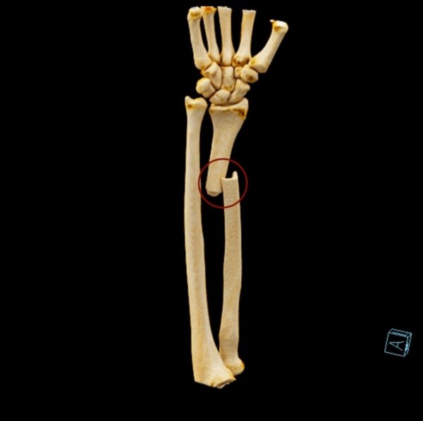 Como ficou o braço do jogador após a fratura Como ficou o braço do jogador após a fratura