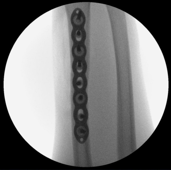 Após a cirurgia, com as placas e parafusos Após a cirurgia, com as placas e parafusos