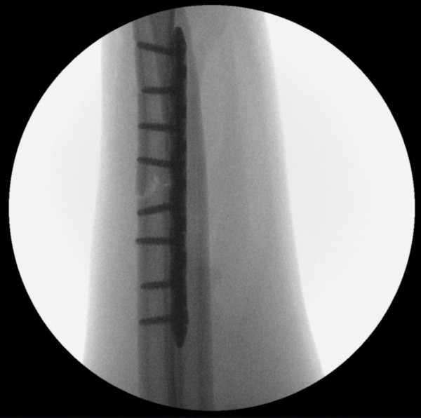 Após a cirurgia, com as placas e parafusos Após a cirurgia, com as placas e parafusos