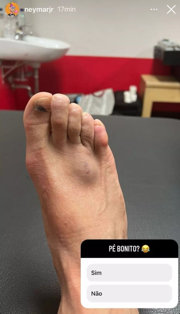 Foto: Reprodução/ Instagram | Neymar postou foto do pé lesionado nos stories do Instagram